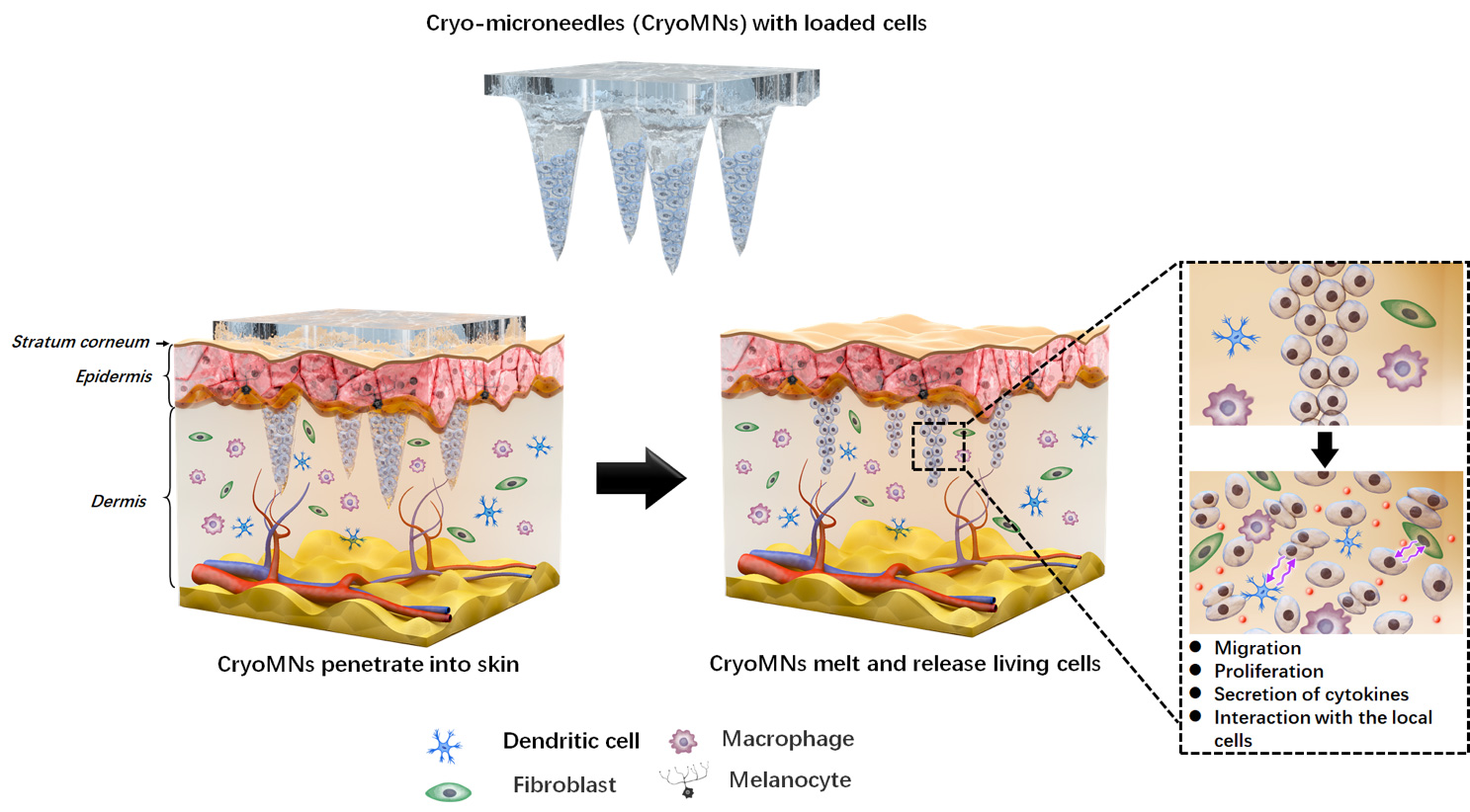 Ice microneedle patches