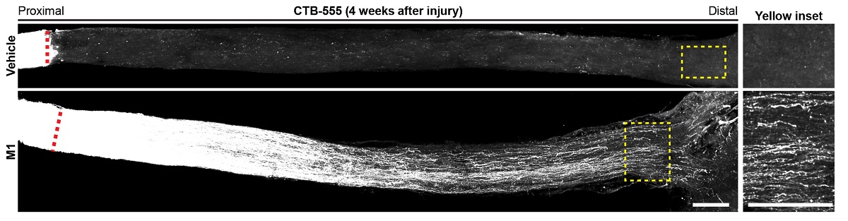 optic nerve injury